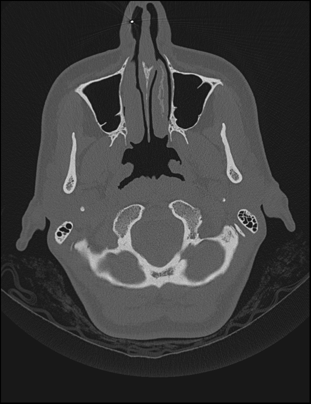 Aberrant right internal carotid artery (Radiopaedia 65191-74198 Axial non-contrast 10).jpg