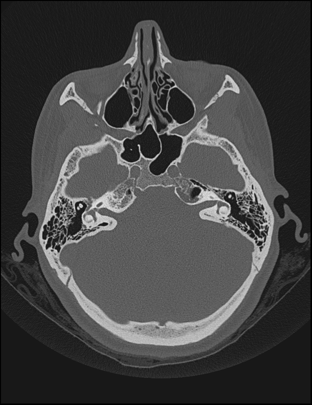 Aberrant right internal carotid artery (Radiopaedia 65191-74198 Axial non-contrast 47).jpg