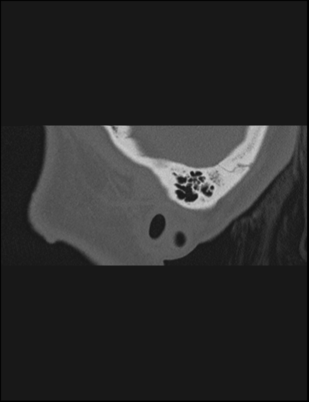 Aberrant right internal carotid artery (Radiopaedia 65191-74198 Sagittal non-contrast 10).jpg