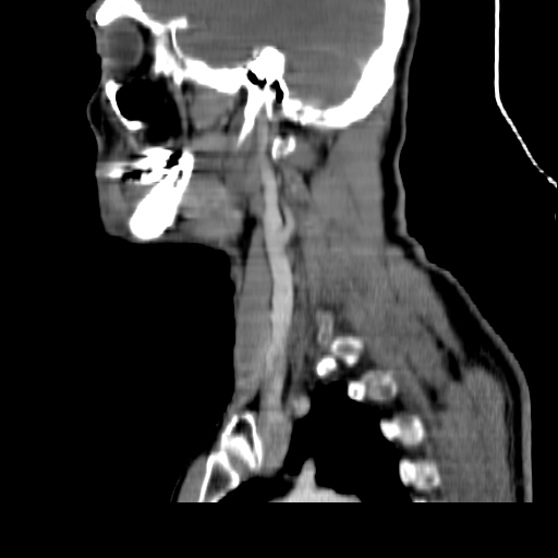 File:Aberrant right subclavian artery (Radiopaedia 26364-26497 Sagittal C+ arterial phase 5).jpg