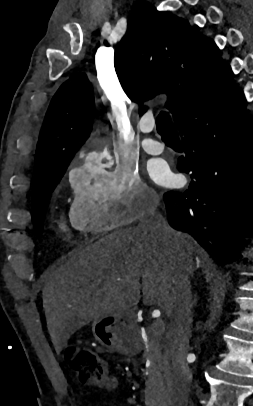 Accessory left atrial appendage (Radiopaedia 81987-95968 Sagittal C+ arterial phase 11).jpg