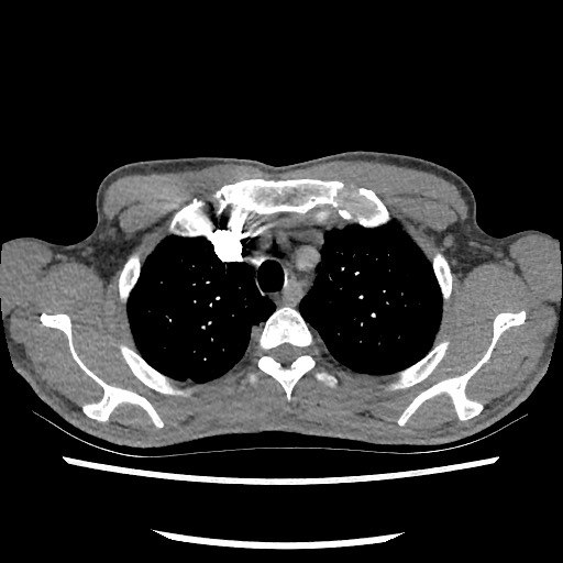 Accessory left horizontal fissure with lingular pneumonia (Radiopaedia 53763-59843 Axial C+ CTPA 21).jpg