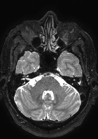 Accessory middle cerebral artery (Radiopaedia 73114-83828 Axial T2 161).jpg