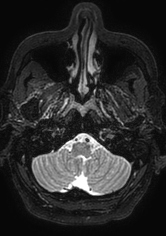 File:Accessory middle cerebral artery (Radiopaedia 73114-83828 Axial T2 202).jpg