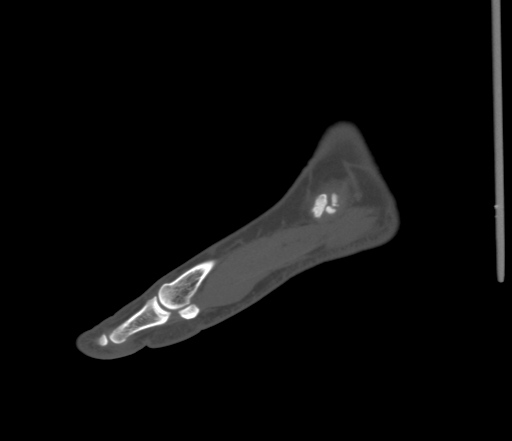 File:Accessory navicular bone (Radiopaedia 54999-61314 Sagittal non-contrast 16).jpg