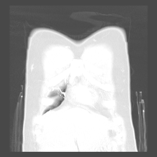 File:Achalasia (Radiopaedia 52507-58417 Coronal lung window 3).jpg