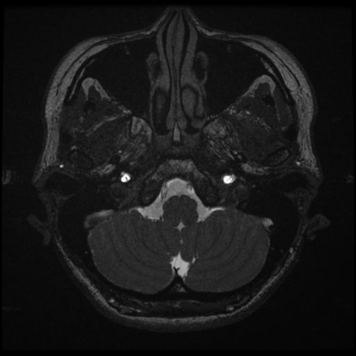 Acoustic neuroma (Radiopaedia 34049-35283 Axial 19).png