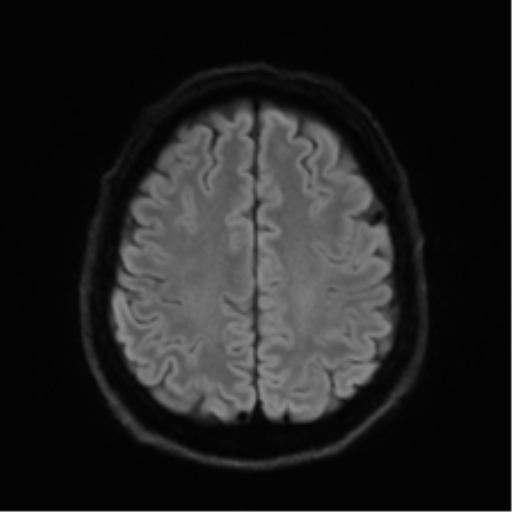Acoustic schwannoma (Radiopaedia 50846-56358 Axial DWI 50).png