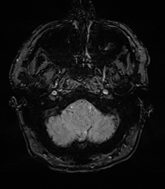 Acoustic schwannoma (Radiopaedia 50846-56358 Axial SWI 11).png