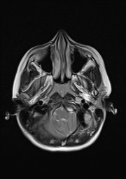File:Acquired cerebellar tonsillar ectopia (Radiopaedia 39950-42423 Axial T2 3).jpg