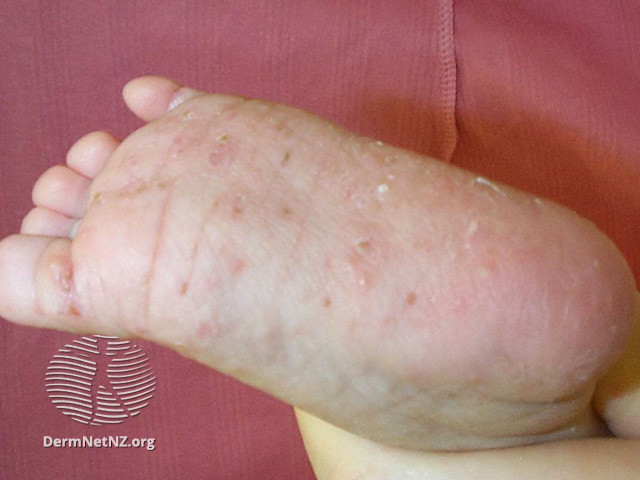File:Acropustulosis of infancy (DermNet NZ site-age-specific-acropustulosis1).jpg