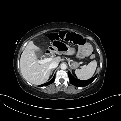 Active Crohn disease (Radiopaedia 59394-66750 Axial C+ portal venous phase 19).jpg