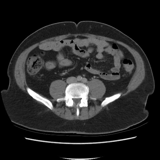 File:Active colonic bleed on CT (Radiopaedia 49765-55025 Axial C+ delayed 52).jpg