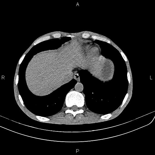 Active crohn disease (Radiopaedia 87133-103397 Axial non-contrast 10).jpg