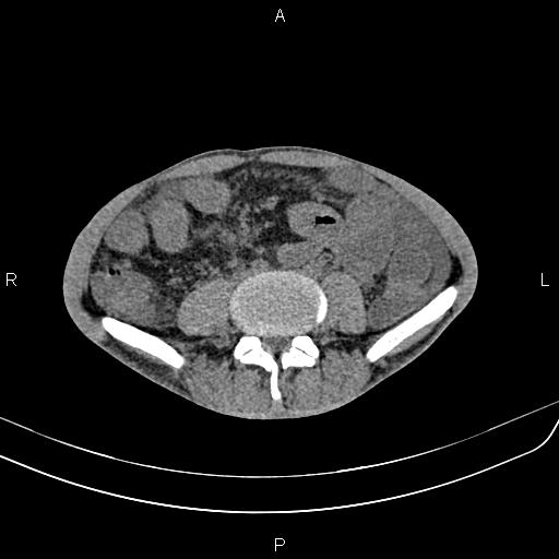 Active crohn disease (Radiopaedia 87133-103397 Axial non-contrast 63).jpg