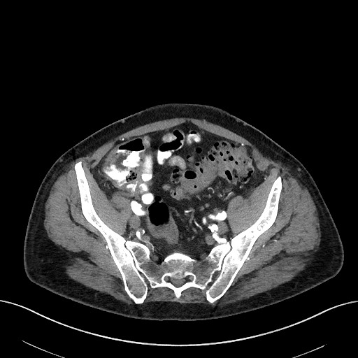 Active lower gastrointestinal bleeding - diverticular (Radiopaedia 61203-69106 Axial C+ arterial phase 40).jpg