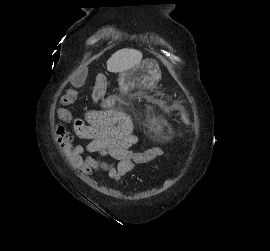 Active renal extravasation with large subcapsular and retroperitoneal hemorrhage (Radiopaedia 60975-68796 Coronal C+ portal venous phase 35).jpg