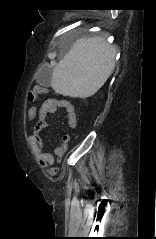 Active renal extravasation with large subcapsular and retroperitoneal hemorrhage (Radiopaedia 60975-68796 Sagittal C+ portal venous phase 177).jpg