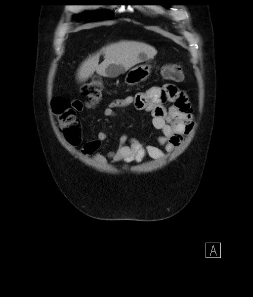 Acute-on-chronic pancreatitis (Radiopaedia 67286-76656 Coronal C+ portal venous phase 18).jpg