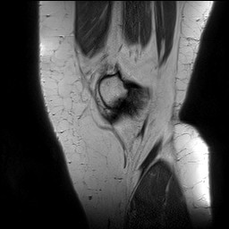 Acute-on-chronic transient lateral patellar dislocation with trochlear dysplasia (Radiopaedia 84099-99349 Sagittal PD 24).jpg