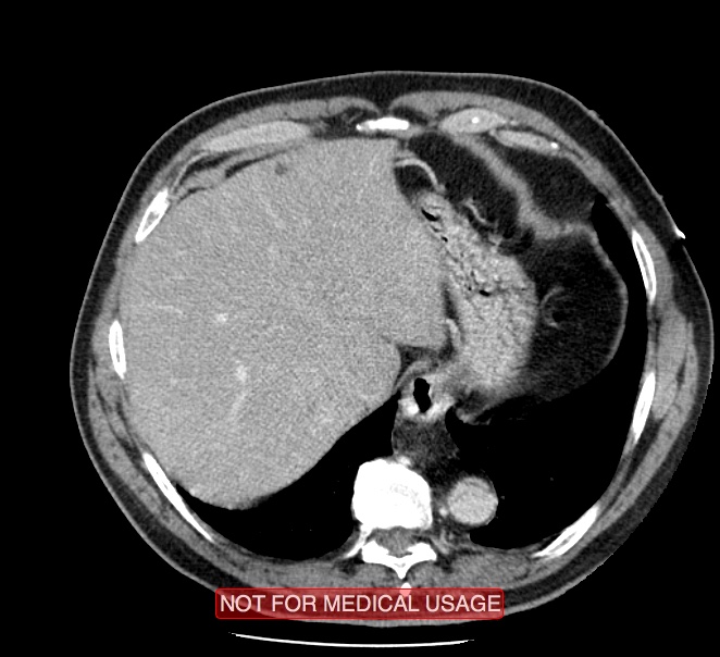 Acute aortic dissection - Stanford type A (Radiopaedia 40661-43285 Axial C+ portal venous phase 56).jpg