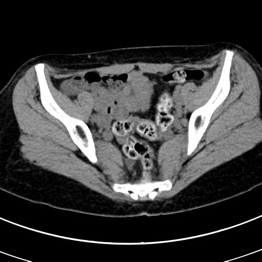 Acute appendicitis (Radiopaedia 30261-30888 Axial non-contrast 84).jpg