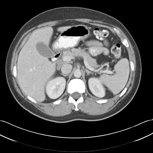 Acute appendicitis (Radiopaedia 30297-30934 Axial C+ portal venous phase 23).jpg