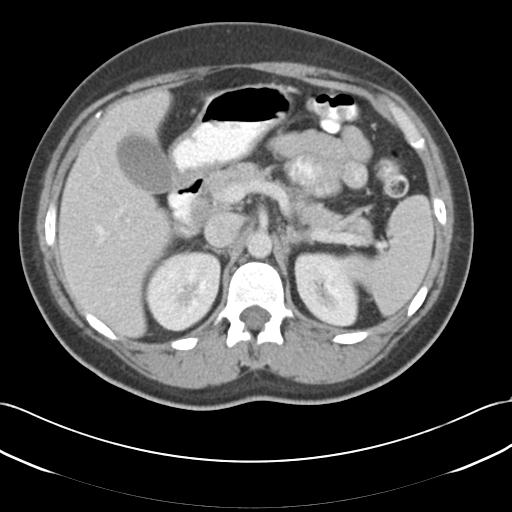 File:Acute appendicitis (Radiopaedia 30297-30934 Axial C+ portal venous phase 24).jpg