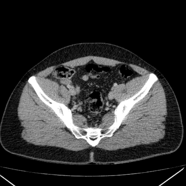 Acute appendicitis (Radiopaedia 38255-40270 Axial C+ portal venous phase 90).jpg