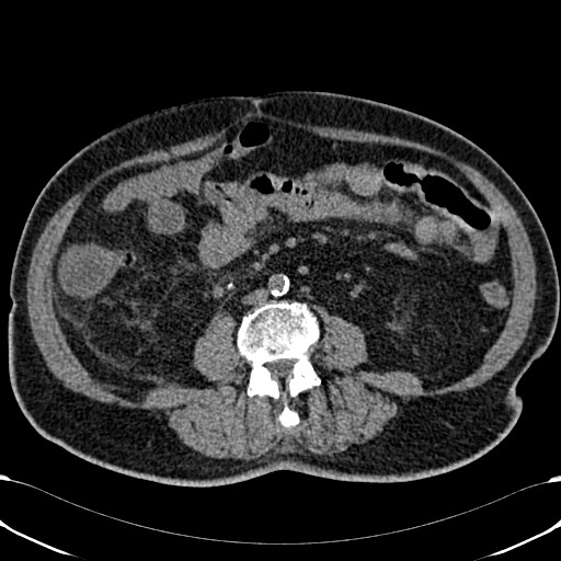 File:Acute appendicitis (Radiopaedia 58627-65818 Axial non-contrast 49).jpg