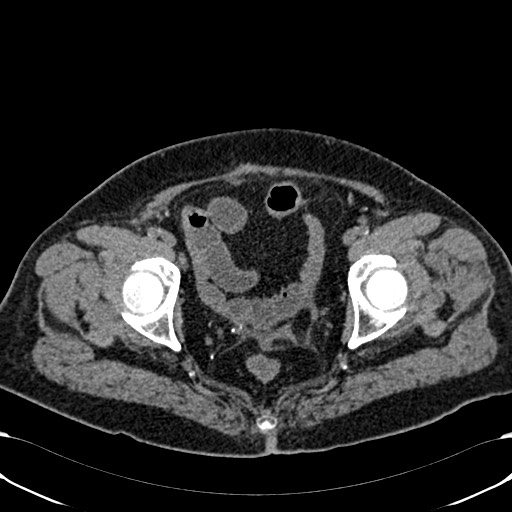 Acute appendicitis (Radiopaedia 58627-65818 Axial non-contrast 80).jpg