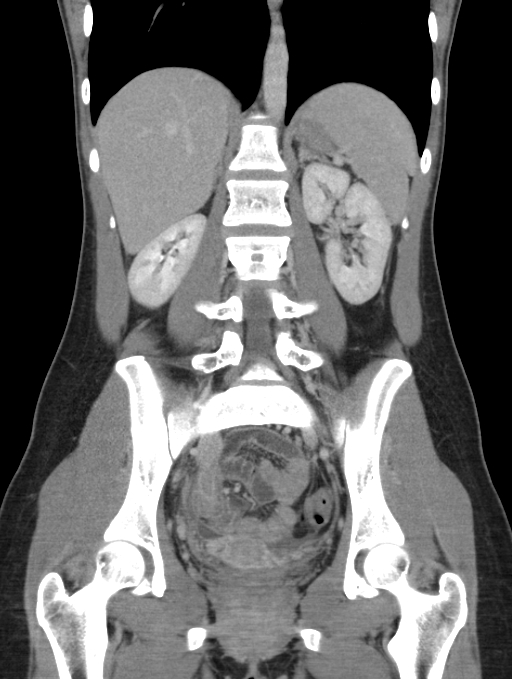 Acute appendicitis (Radiopaedia 62608-70901 Coronal C+ portal venous phase 34).jpg