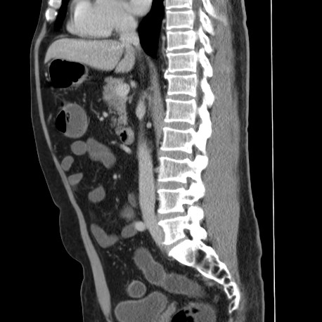 Acute appendicitis (Radiopaedia 66513-75790 Sagittal C+ portal venous phase 76).jpg