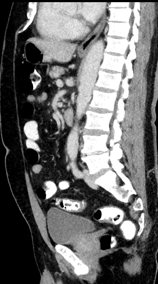 Acute appendicitis (Radiopaedia 77016-88960 Sagittal C+ portal venous phase 54).jpg