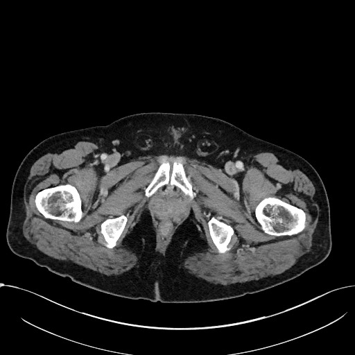 File:Acute appendicitis - large appendicoliths (Radiopaedia 61805-69820 Axial C+ portal venous phase 138).jpg