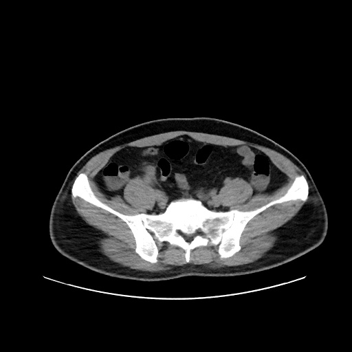 Acute appendicitis and COVID 19 pneumonia (Radiopaedia 76604-88380 Axial non-contrast 99).jpg