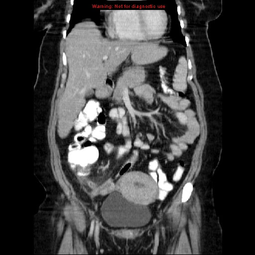 Acute appendicitis complicated by ovarian vein thrombophlebitis (Radiopaedia 16172-15851 Coronal C+ portal venous phase 32).jpg