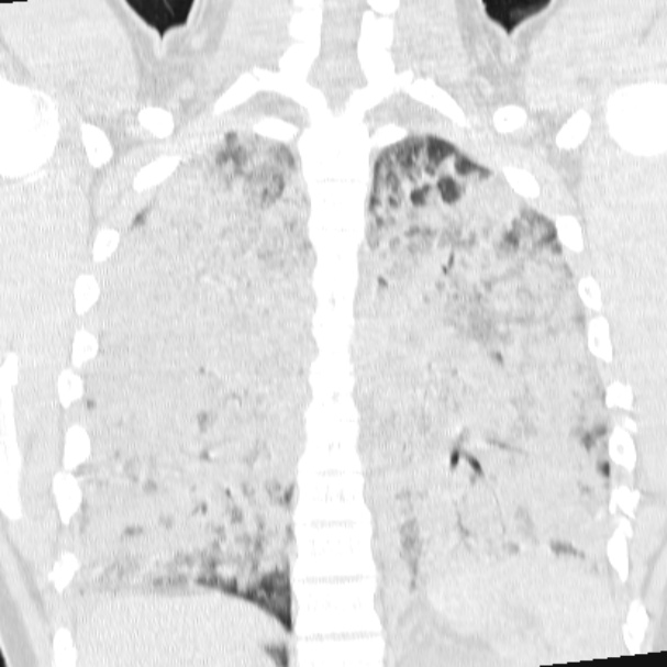 Acute aspiration pneumonitis (Radiopaedia 33605-34703 Coronal lung window 56).jpg