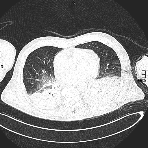 Acute aspiration pneumonitis (Radiopaedia 55642-62166 Axial lung window 99).jpg