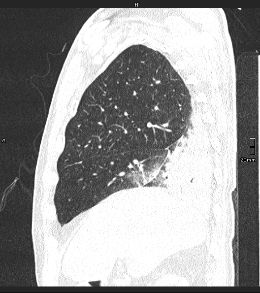 Acute aspiration pneumonitis (Radiopaedia 55642-62166 Sagittal lung window 114).jpg