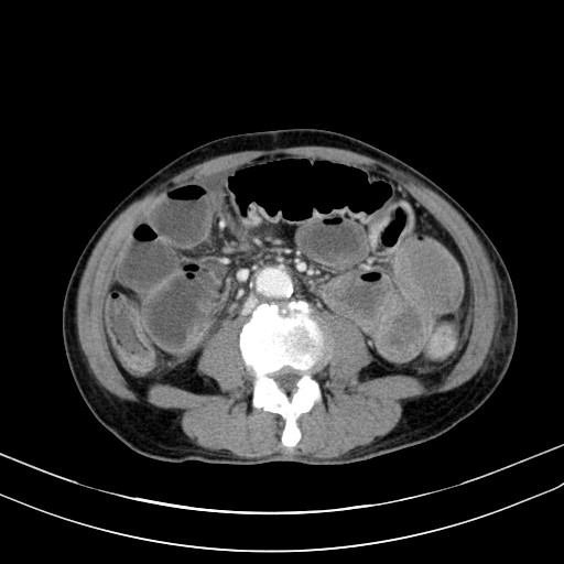 Acute bowel ischemia (Radiopaedia 87695-104114 Axial C+ portal venous phase 47).jpg