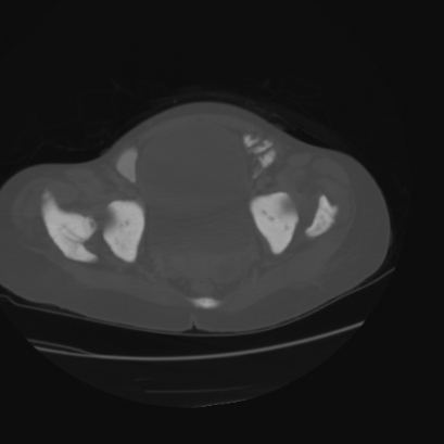 File:Acute calculous cholecystitis in patient with osteopetrosis (Radiopaedia 77871-90159 Axial bone window 46).jpg