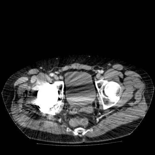 Acute cholecystitis and incidental left sided IVC (Radiopaedia 49352-54459 Axial C+ portal venous phase 145).jpg