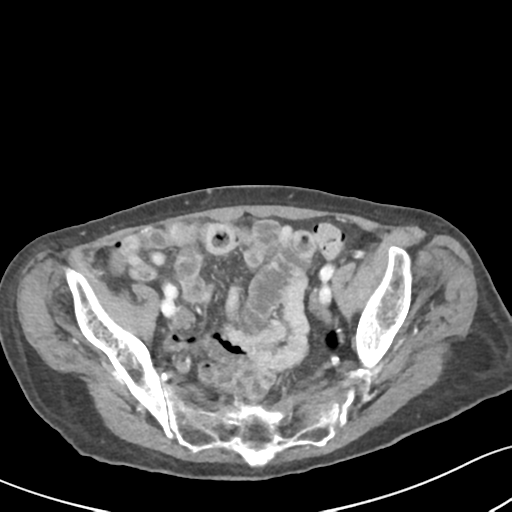 Acute cholecystitis with contained perforation (Radiopaedia 47328-51907 Axial C+ portal venous phase 58).png