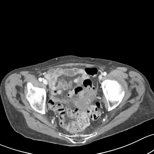 Acute cholecystitis with contained perforation (Radiopaedia 47328-51907 Axial C+ portal venous phase 64).png