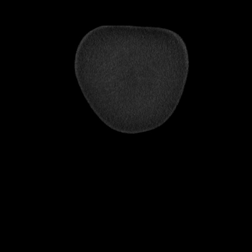 Acute cholecystitis with tensile fundus sign (Radiopaedia 71394-81723 Coronal non-contrast 10).jpg