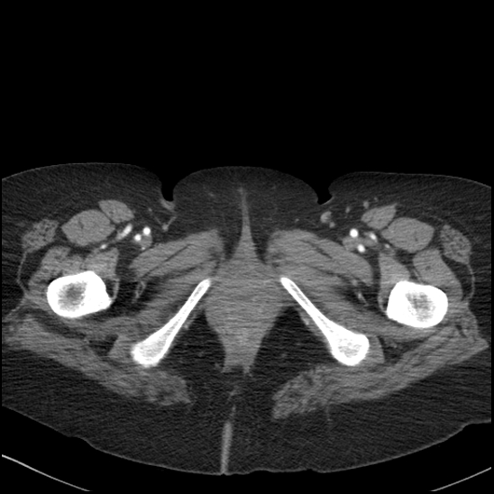 Acute colonic hemorrhage in ulcerative colitis (Radiopaedia 77415-89538 Axial C+ arterial phase 144).jpg