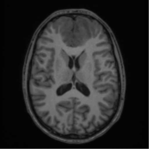 Acute disseminated encephalomyelitis (ADEM) (Radiopaedia 65319-74349 Axial T1 38).png