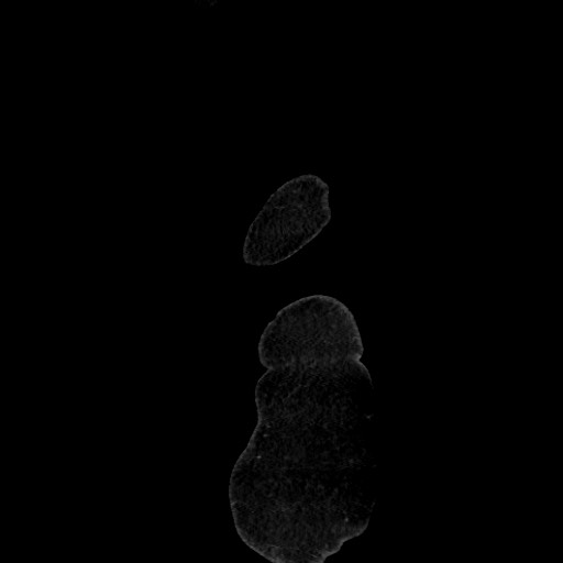 Acute diverticulitis - transverse colon (Radiopaedia 87063-103327 Sagittal C+ portal venous phase 10).jpg