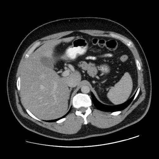 Acute diverticulitis with localized perforation (Radiopaedia 41296-44113 Axial C+ portal venous phase 24).jpg